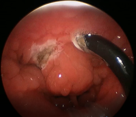 4.4mm Diameterpla402 Tonsilectomy Toverstokje voor Medische Chirurgie