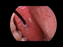 Snurken Behandeling Radiofrequentie Plasma Generator Met Multifunctionele Probe