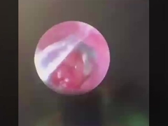 Butterfly ENT Chirurgische instrumenten ENT Probe