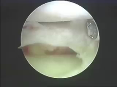 Van de Ablatiesystemen van Electrosurgicalinstrumenten de Ablatieproducten voor Stekel en Verbindingen