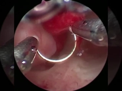 Koele technologie Plasmachirurgie Elektrode Voor Urologie BPH-procedures