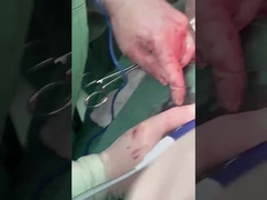 Hepatologische proefplaat PLA408 voor open chirurgie